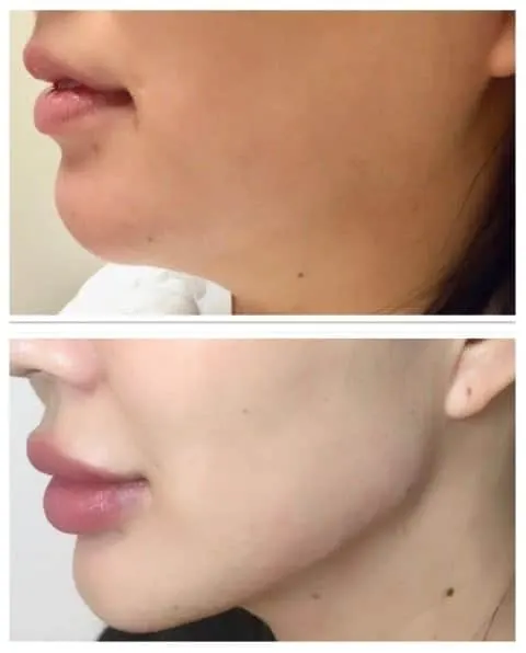 Fillers Jawline Lip Before and after Berkeley CA