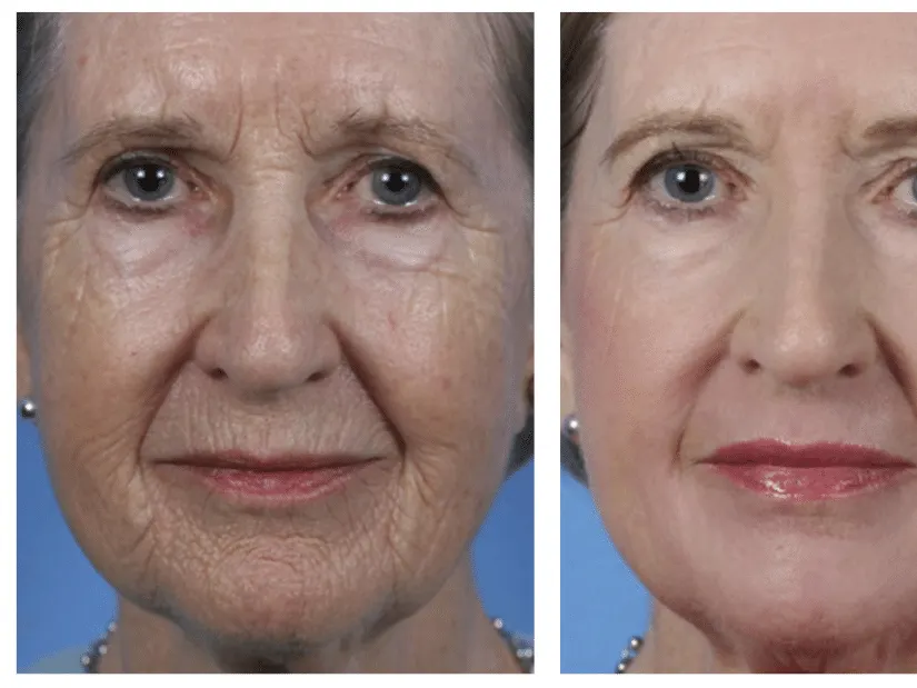 Two close-up photographs of an older woman's face side by side against a blue background.