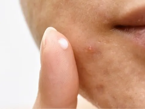 Stock photograph of a model: close-up of a person's lower face and chin with a fingertip holding a small dab of cream.