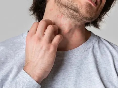 Stock photograph of a model: man in a gray shirt scratching his neck, which shows small red spots.