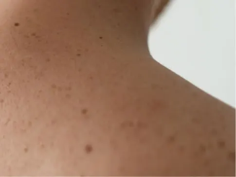 Stock photograph of a model: close-up of a bare upper back and shoulder with several small moles and freckles.
