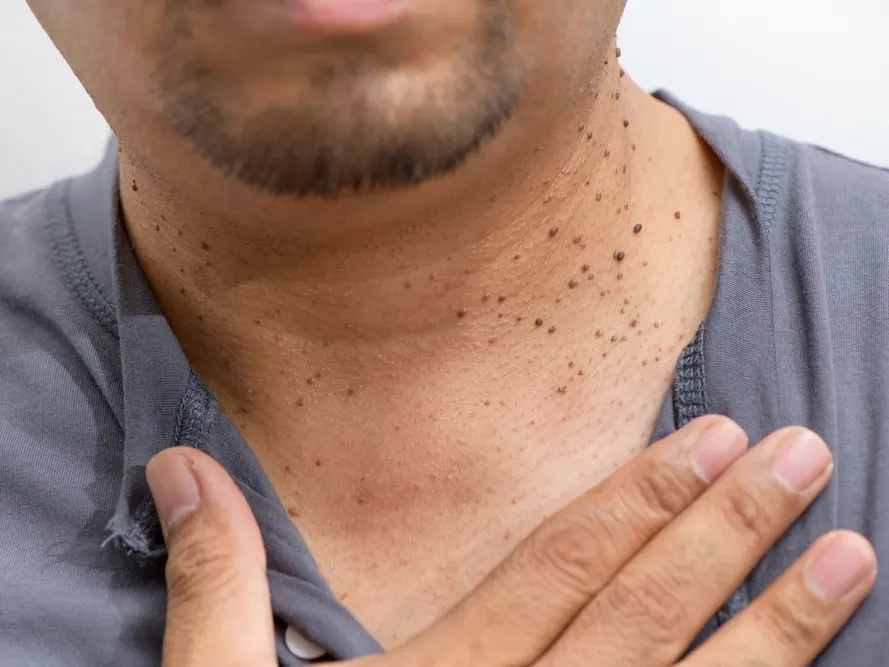 Stock photograph of a model: a man's neck and chest with several dark spots on the skin, as he touches his collarbone