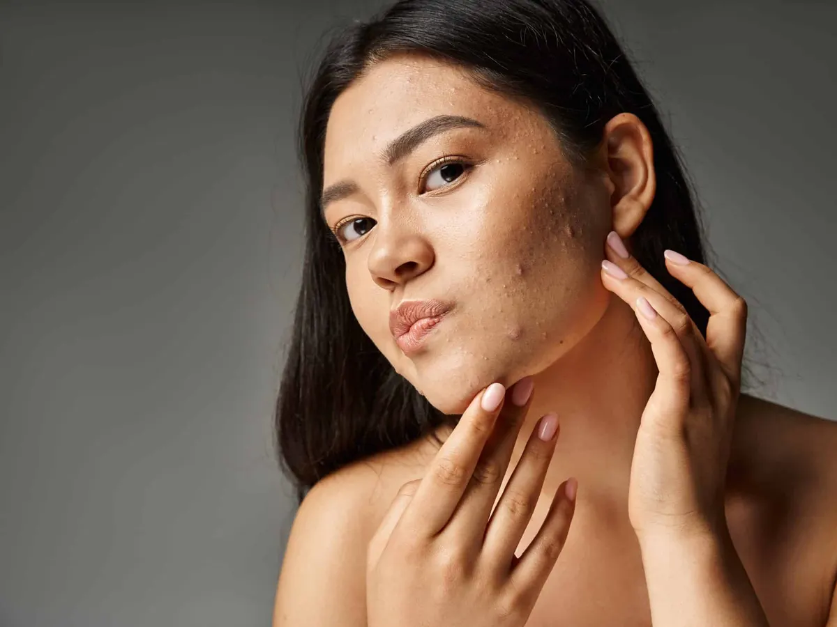 Stock photograph of a model: a woman with bare shoulders and dark hair touches her neck, with acne marks on her cheek