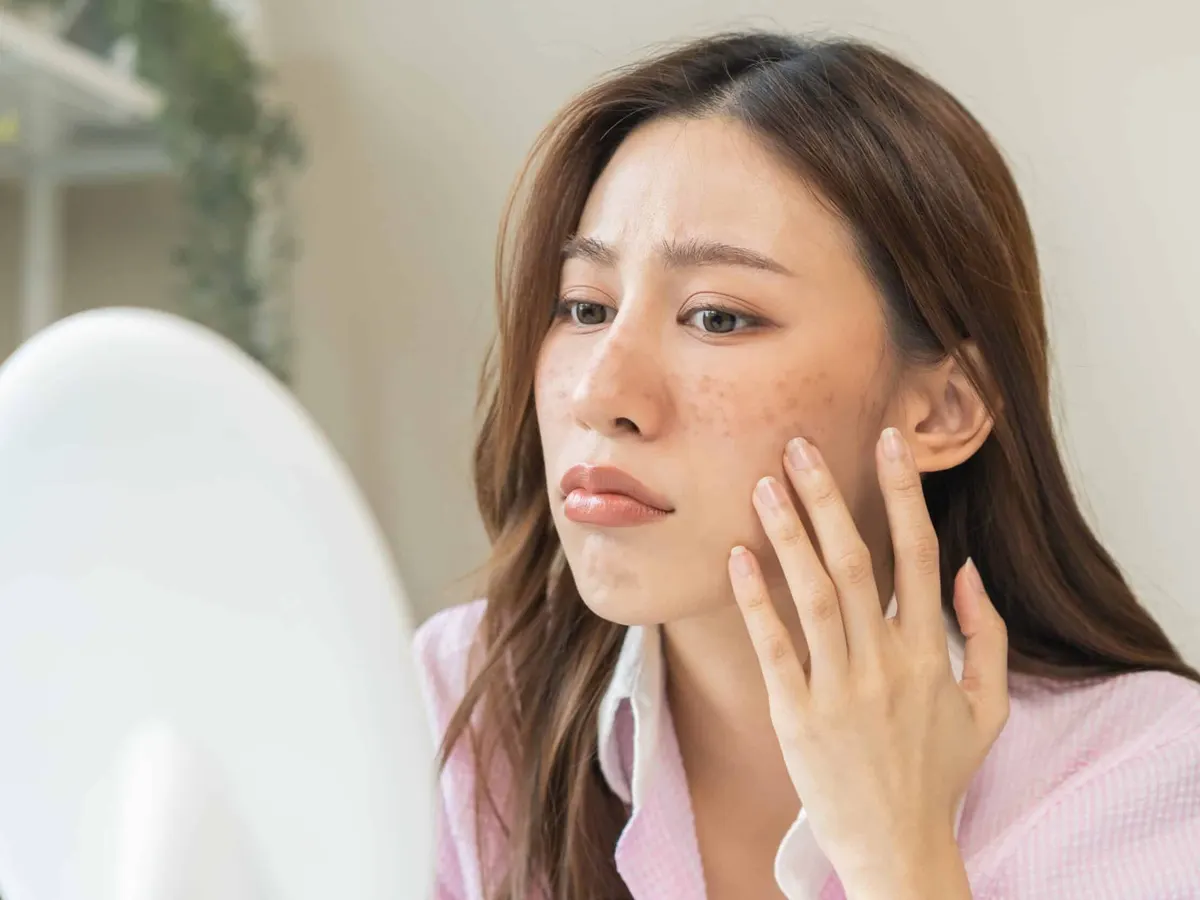 Stock photograph of a model: a woman studies dark patches on her cheek in a mirror