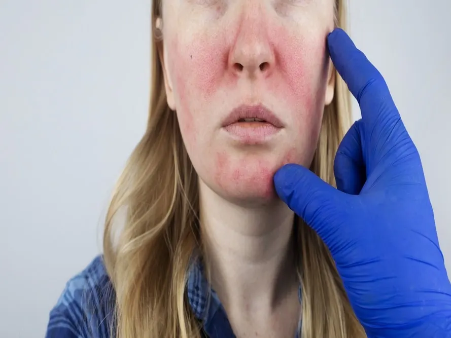 Stock photograph of a model: a gloved hand points to redness across a woman's cheeks and nose