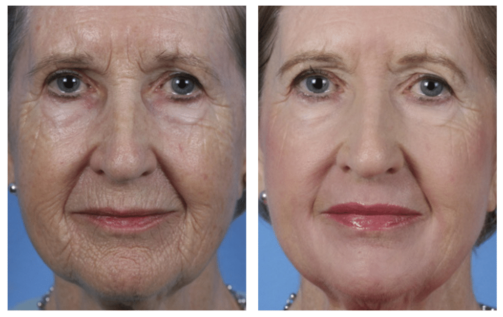 Two close-up photographs of an older woman's face side by side against a blue background.