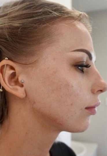 After Image: Fillers - right-side