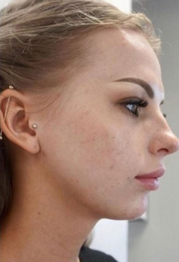 Before Image: Fillers - right-side