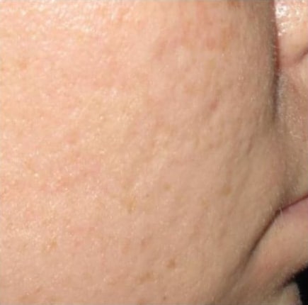 After Image: Microneedling - right-side