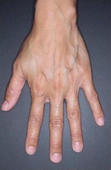 Before Image: Fillers - front