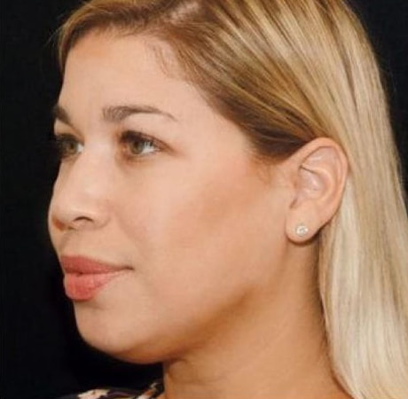 Before Image: Fillers - left-front-oblique