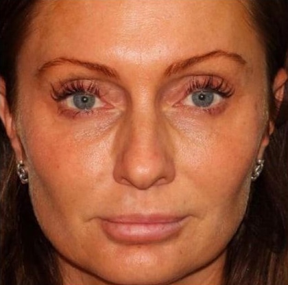 After Image: Fillers - front