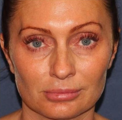 Before Image: Fillers - front