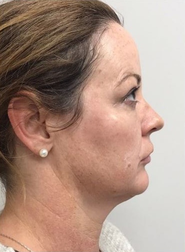 After Image: Fillers - right-side