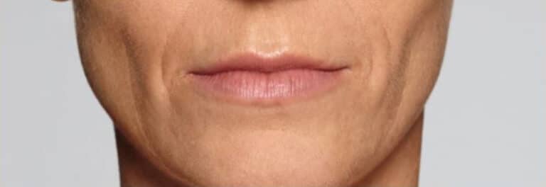Before Image: Fillers - front