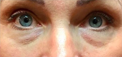 Before Image: Fillers - front
