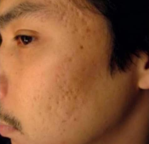 Before Image: Microneedling - left-front-oblique