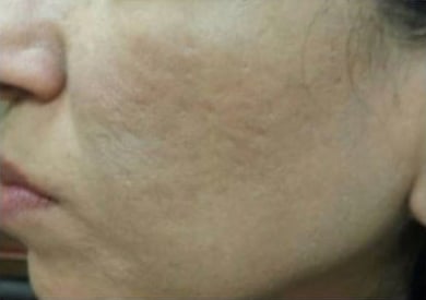 After Image: Microneedling - left-side