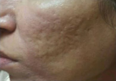 Before Image: Microneedling - left-side