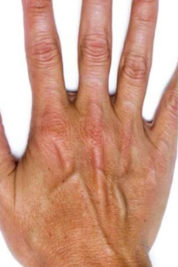 Before Image: Fillers - front