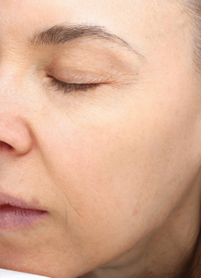 After Image: Fractional Laser - left-front-oblique