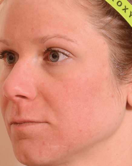 After Image: Fractional Laser - left-front-oblique