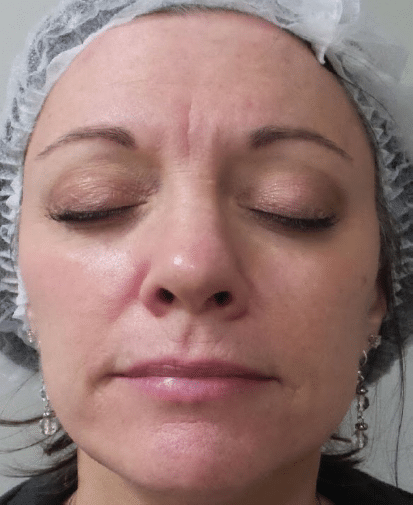 After Image: Fractional Laser - front