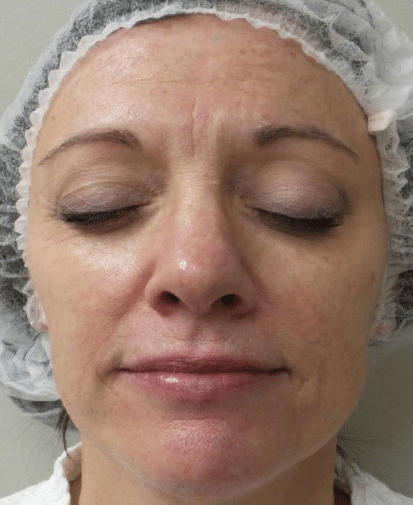 Before Image: Fractional Laser - front