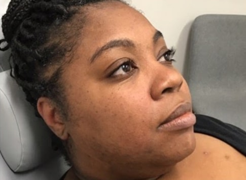 After Image: Dermaplaning - right-front-oblique