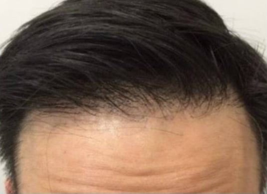 After Image: Hair Restoration - front