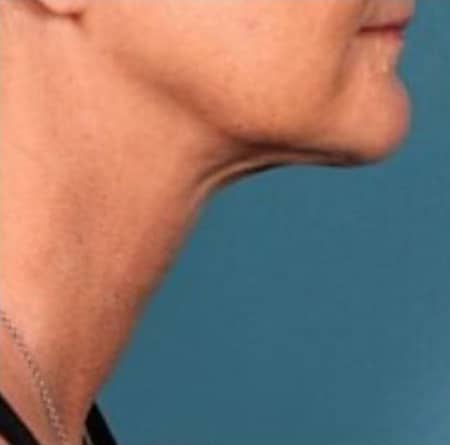 After Image: Kybella - right-side