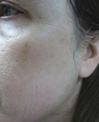 After Image: Laser Treatments - left-front-oblique