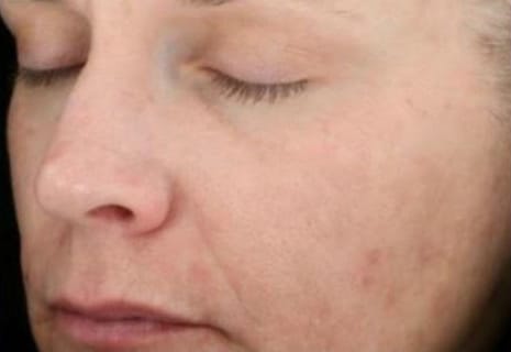 After Image: Chemical Peels - left-front-oblique