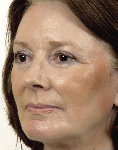 After Image: Laser Resurfacing - left-front-oblique