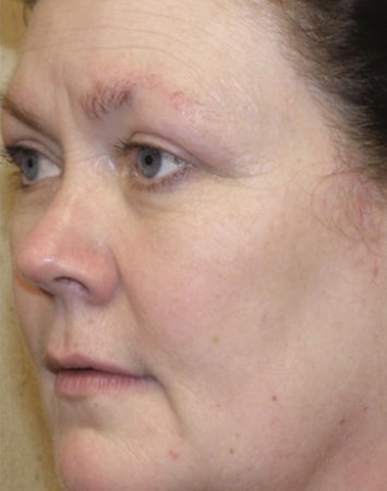 After Image: Laser Treatments - left-front-oblique