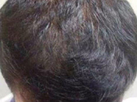 After Image: Hair Restoration - front