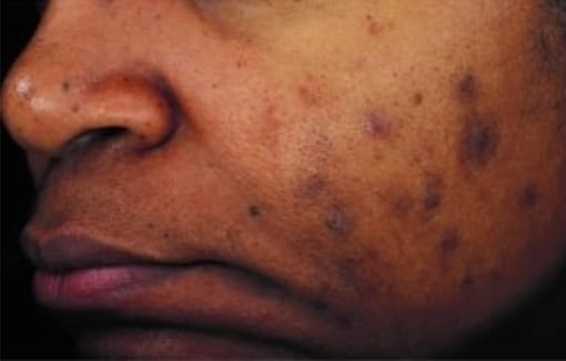 Before Image: Chemical Peels - left-front-oblique