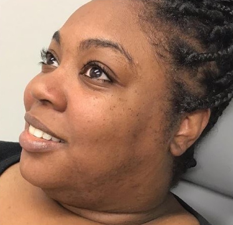 After Image: Dermaplaning - left-front-oblique