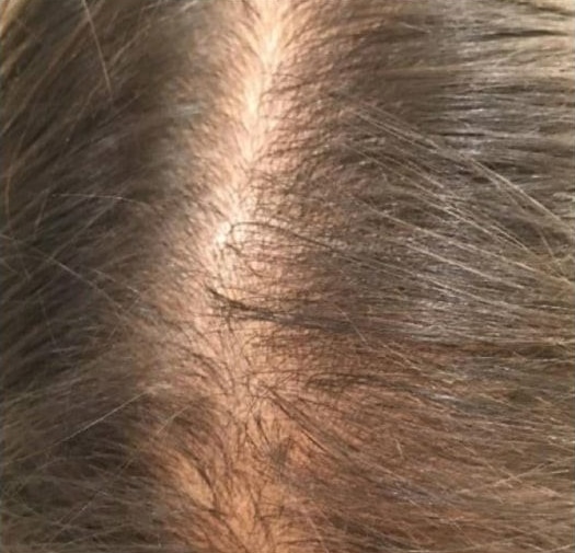 Before Image: Hair Restoration - front