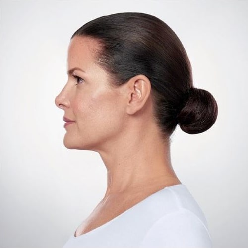 After Image: Kybella - left-side