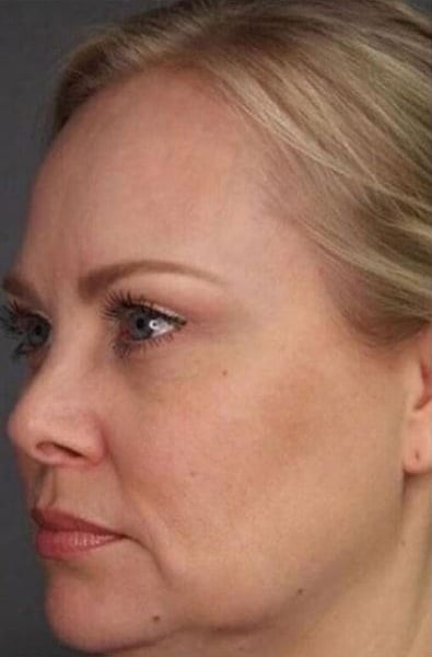 Before Image: Kybella - left-front-oblique