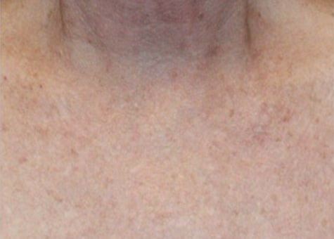 After Image: Laser Treatments - front