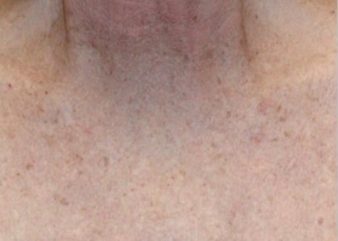 Before Image: Laser Treatments - front