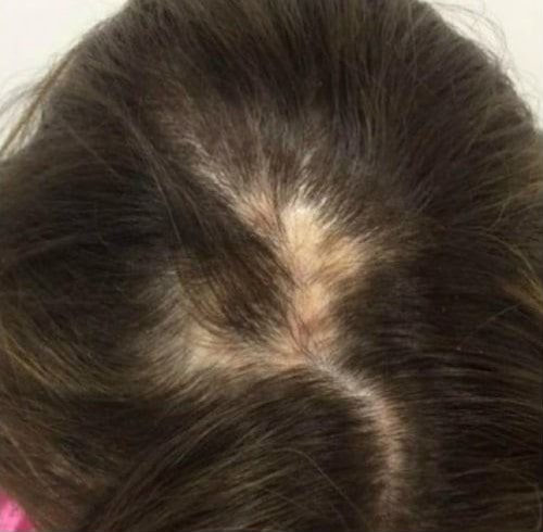 Before Image: Hair Restoration - front