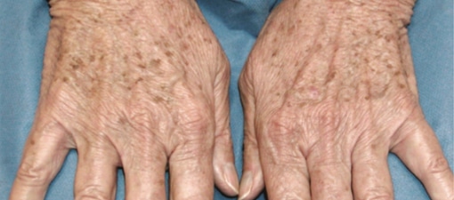 Before Image: Laser Treatments - front