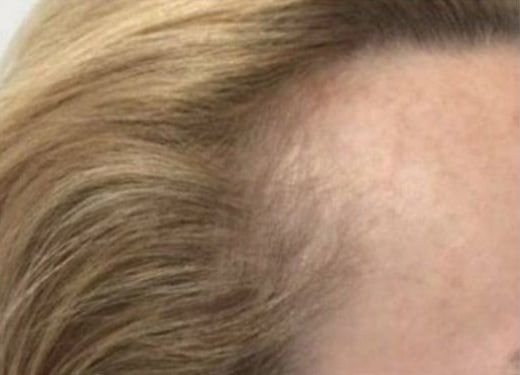 After Image: Hair Restoration - right-side