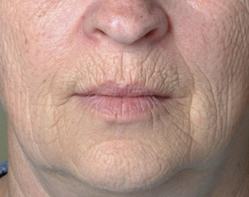 Before Image: Laser Resurfacing - front