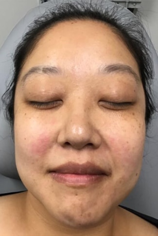 Before Image: Laser Treatments - front