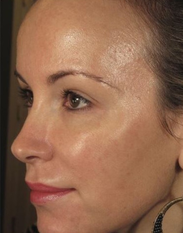 After Image: Laser Treatments - left-side