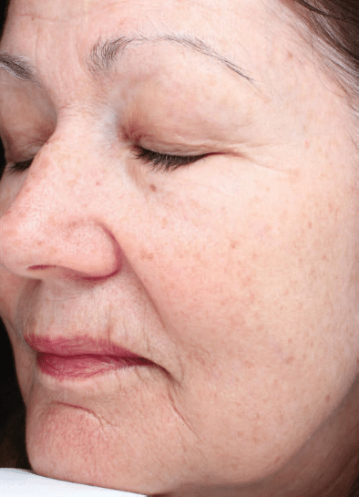 Before Image: Fractional Laser - left-front-oblique